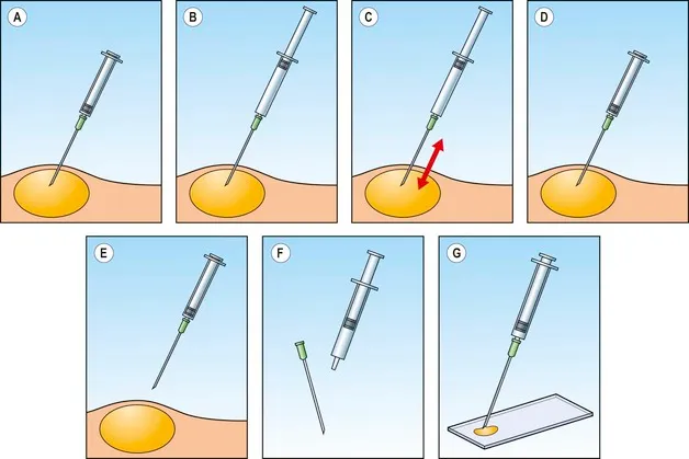 Fine Needle Aspiration Illustration