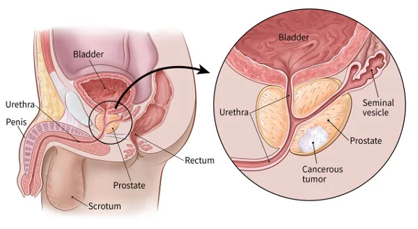 Prostate cancer.