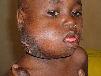 jaw swelling is a typical presentation of Burkitt Lymphoma.