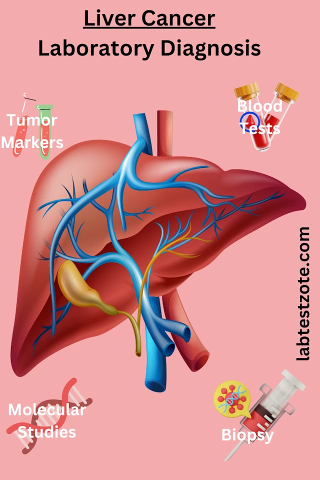 liver cancer - laboratory diagnosis