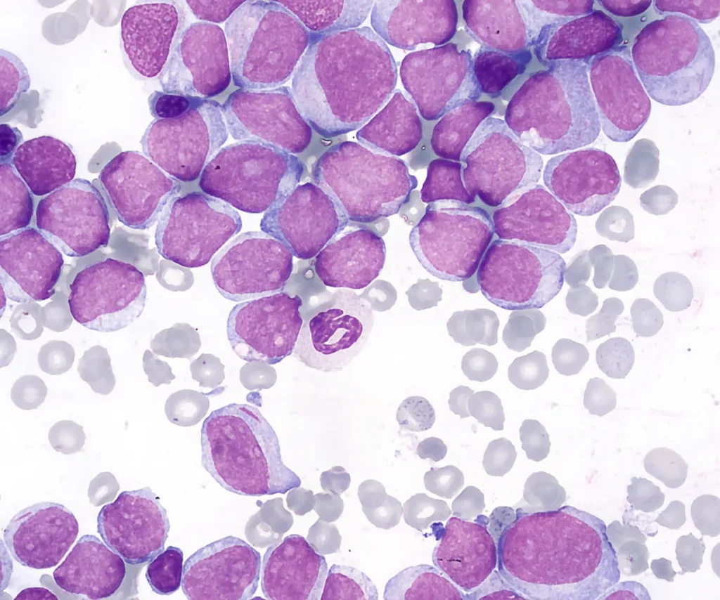 AML bone Marrow Acute Myeloblastic Leukemia - Peripheral Blood film