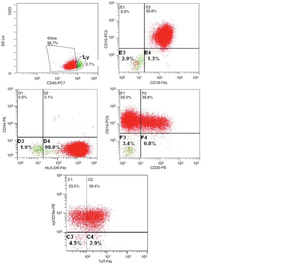 Flow cytometry graph ALL Flow cytometry in ALL